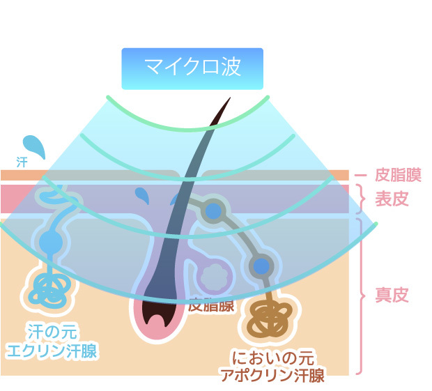 ミラドライの仕組み