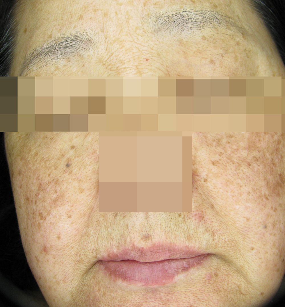 セラピューティックプログラム治療前