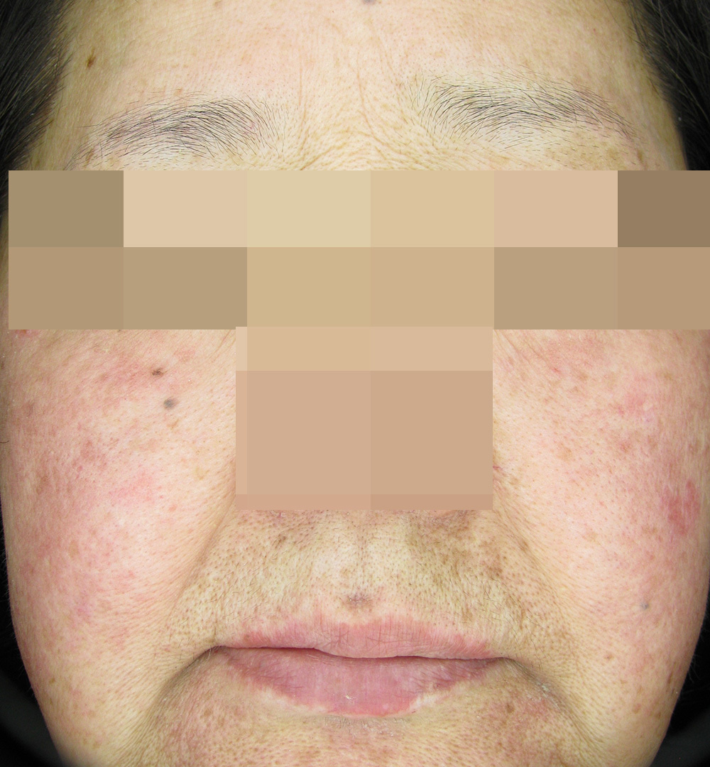 セラピューティックプログラム治療8ヶ月後