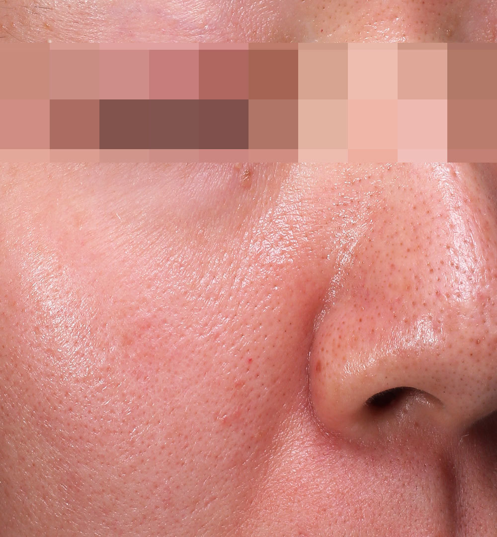 セラピューティックプログラム治療8ヶ月後