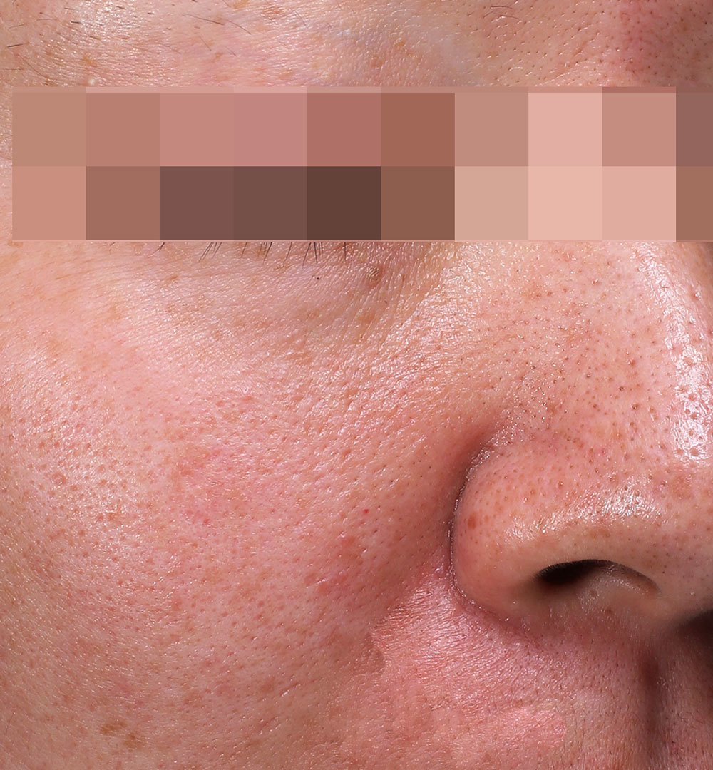 セラピューティックプログラム治療前